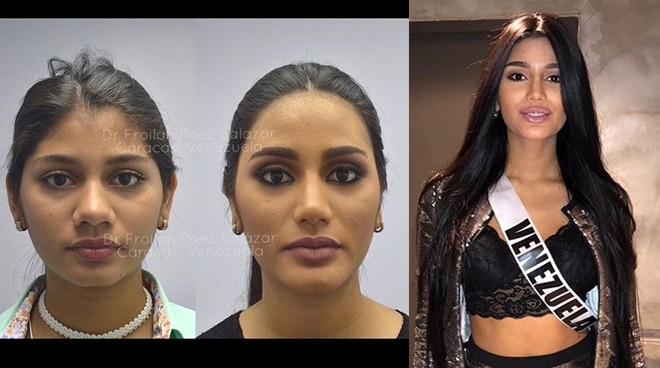 sthefany-gutierrez-undergoes-surgery-pus