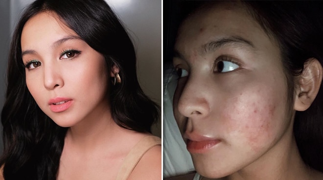 Kyline Alcantara opens up about emotional acne journey ...